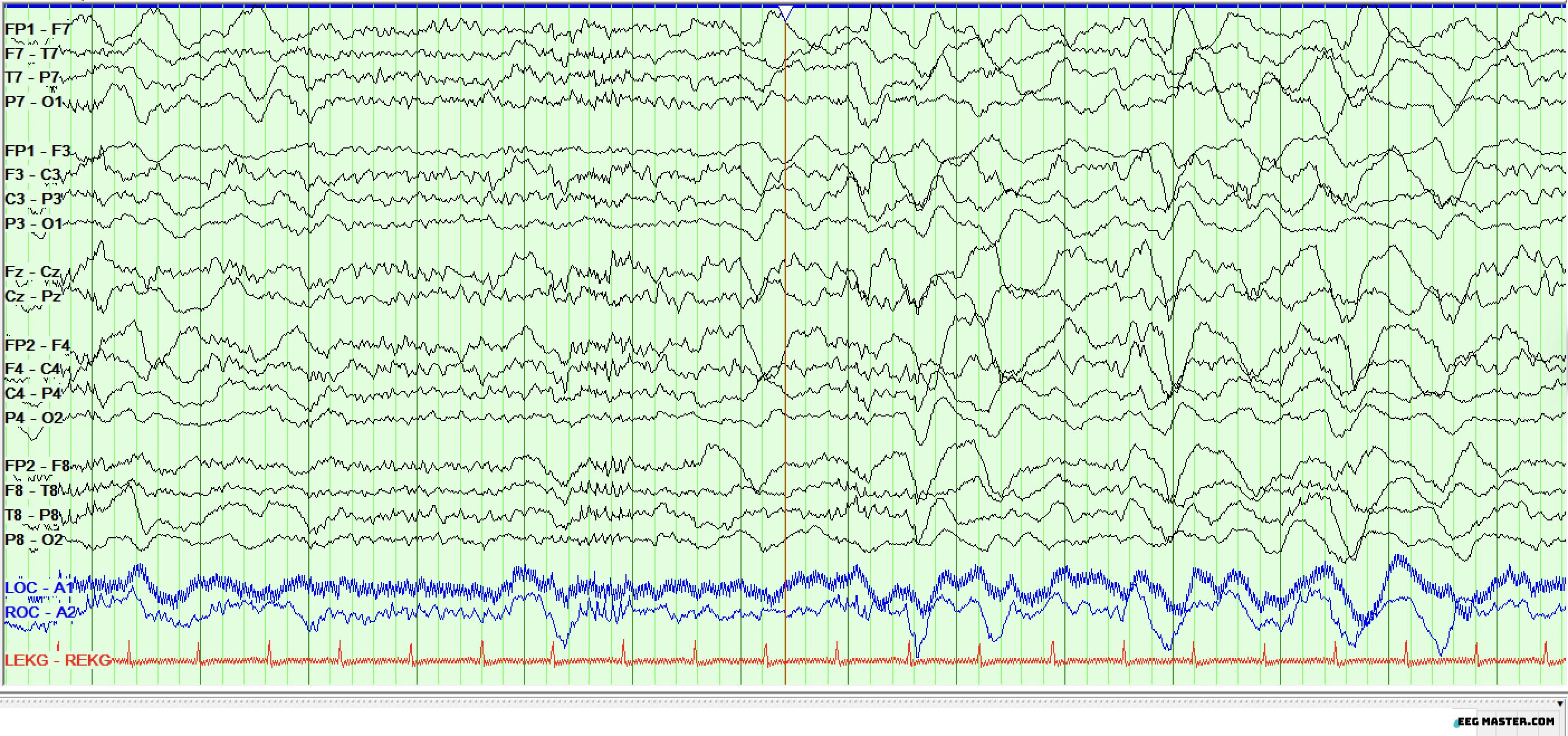 Mu Rythmn Eeg Examples EEG Master- learn EEG