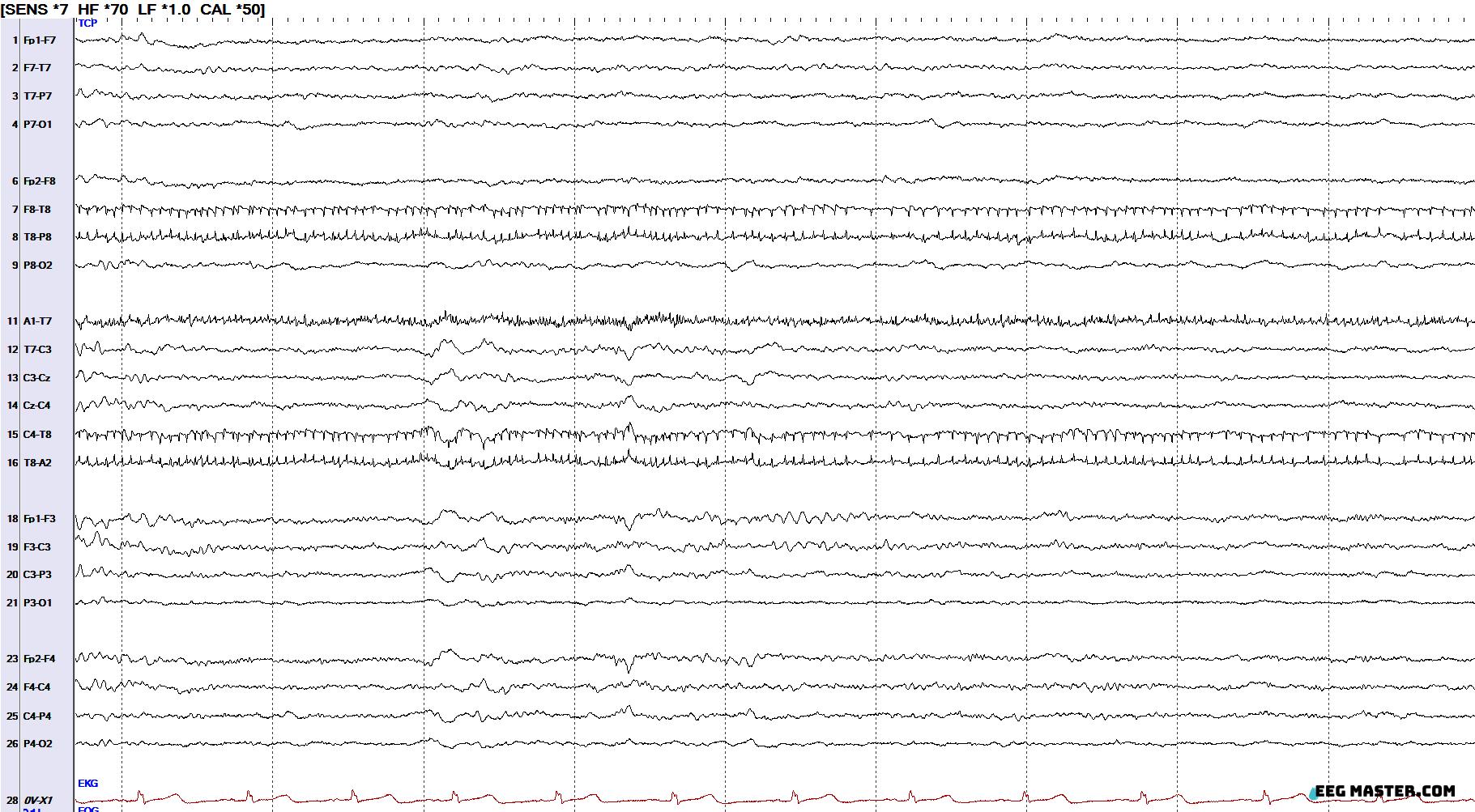 Vertex Wave EEG Master- learn EEG