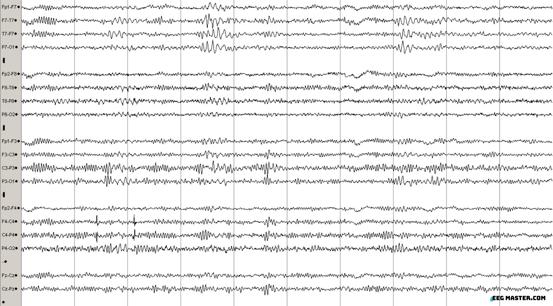 Vertex Wave EEG Master- learn EEG