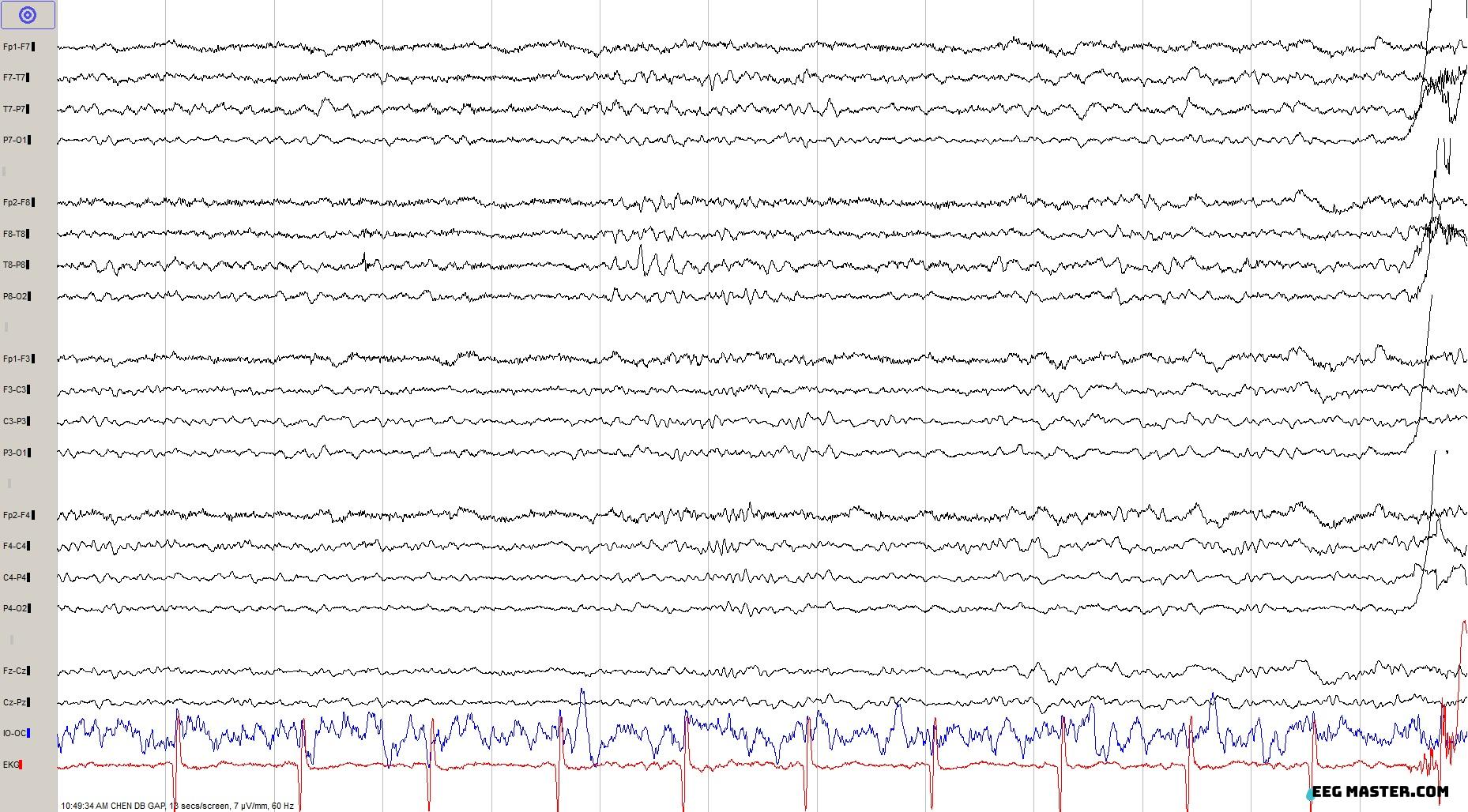 Vertex Wave EEG Master- learn EEG