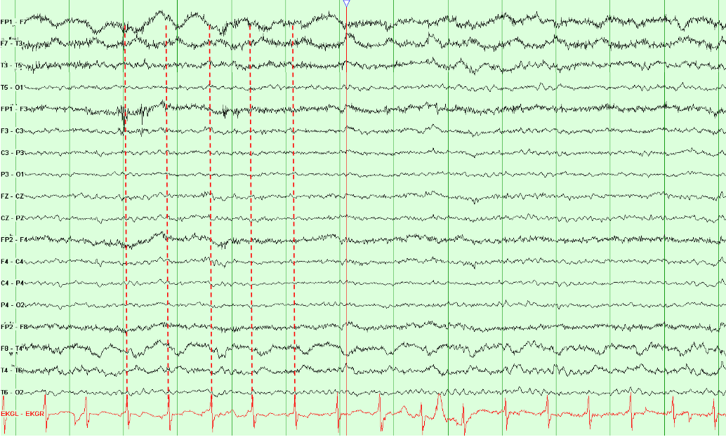 Pulse artifact