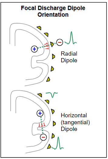 Focal Discharge Dipole Orientation