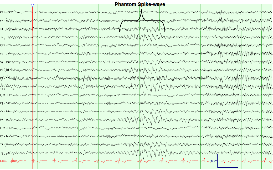6 Hertz Phantom Spike Wave Discharges