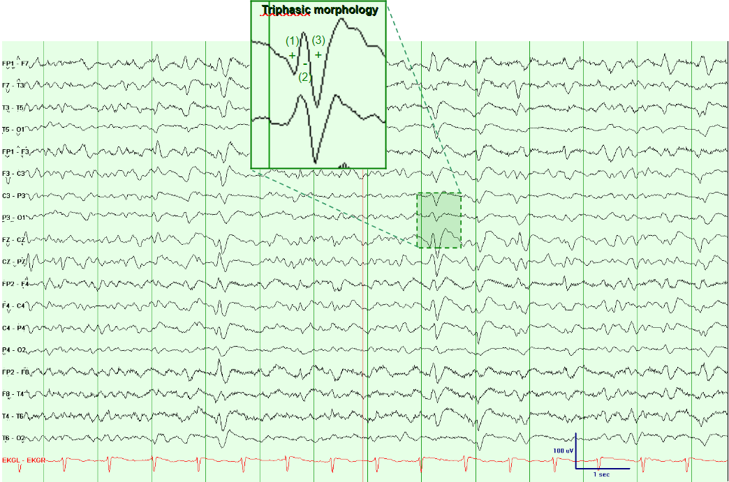Generalized Periodic Discharges with Triphasic Morphology