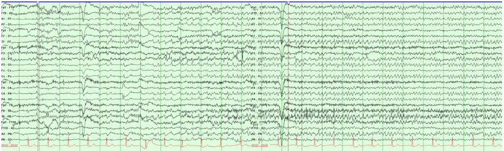 Subclinical Rhythmic Epileptiform Discharges in Adults (SREDA)