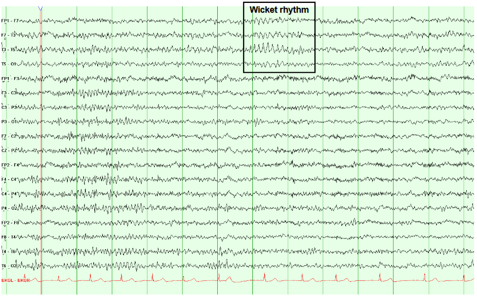 Wicket rhythm