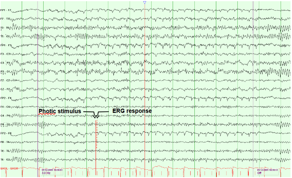 Electroretinogram