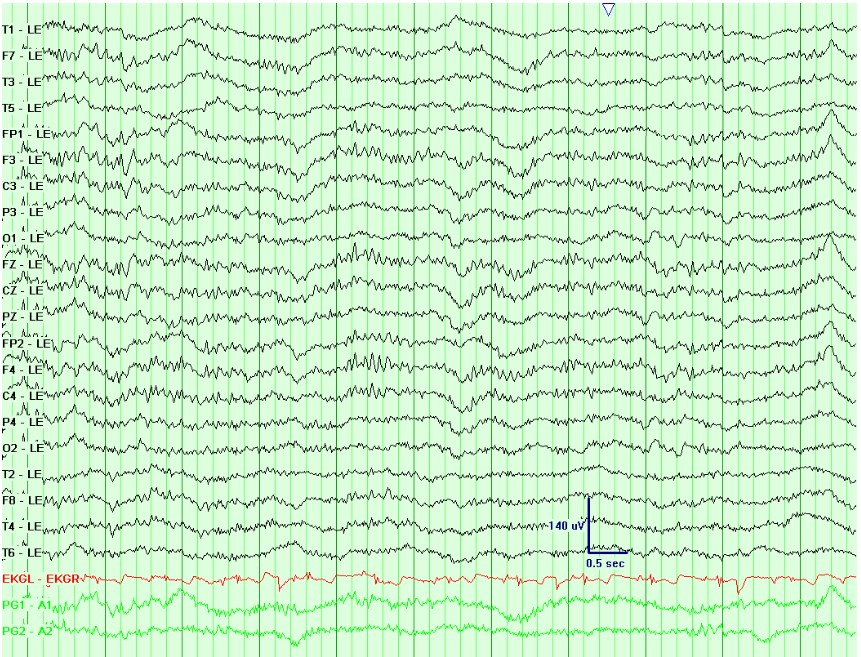 Dominant Frequency is in the beta range but it is usually intermixed delta with loss of reactivity