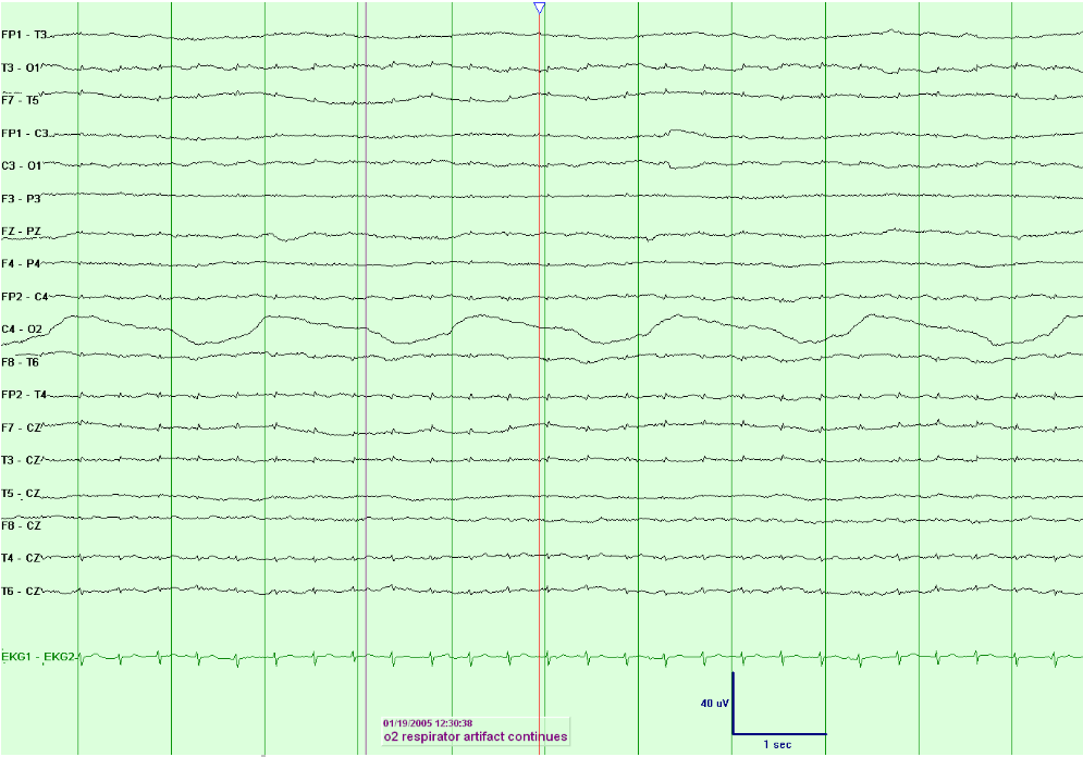 Electrocerebral Inactivity (ECI)