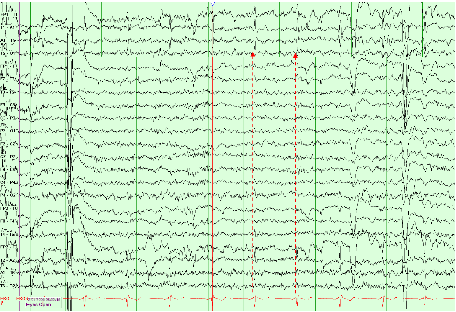 Electrocardiographic Artifacts