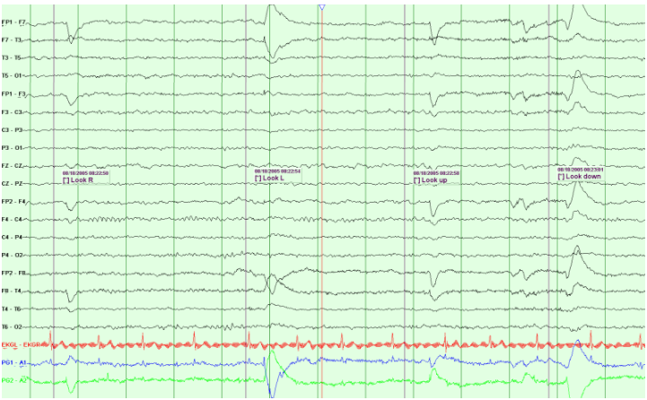 Artifacts are waveforms on an EEG caused by electrical sources other than the cortex.