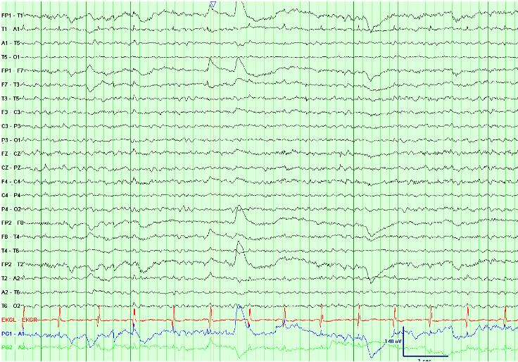 REM sleep has the electrophysiologic characteristics