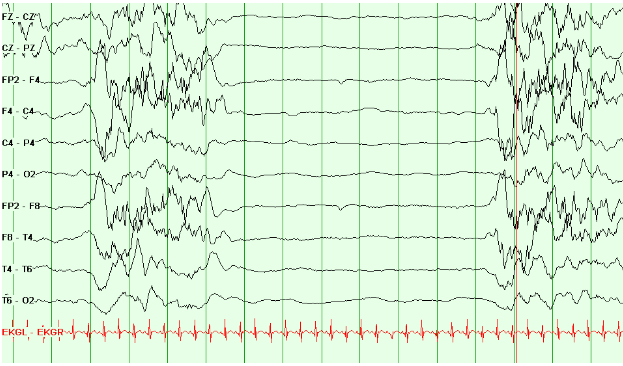 Burst Suppression Pattern