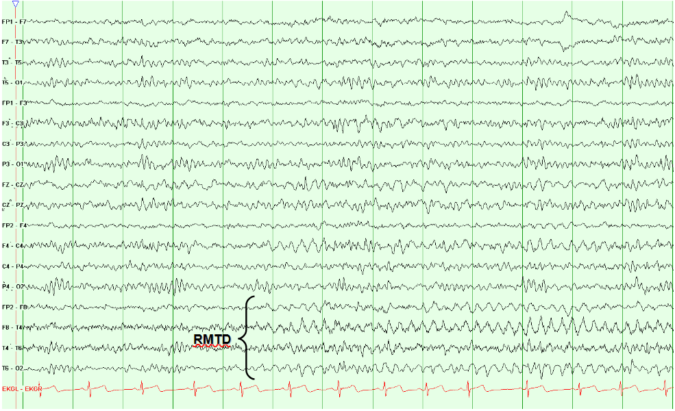Rhythmic Midtemporal Theta of Drowsiness (RMTD)