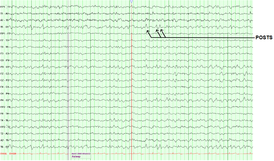 Positive Occipital Transients of Sleep (POSTS)
