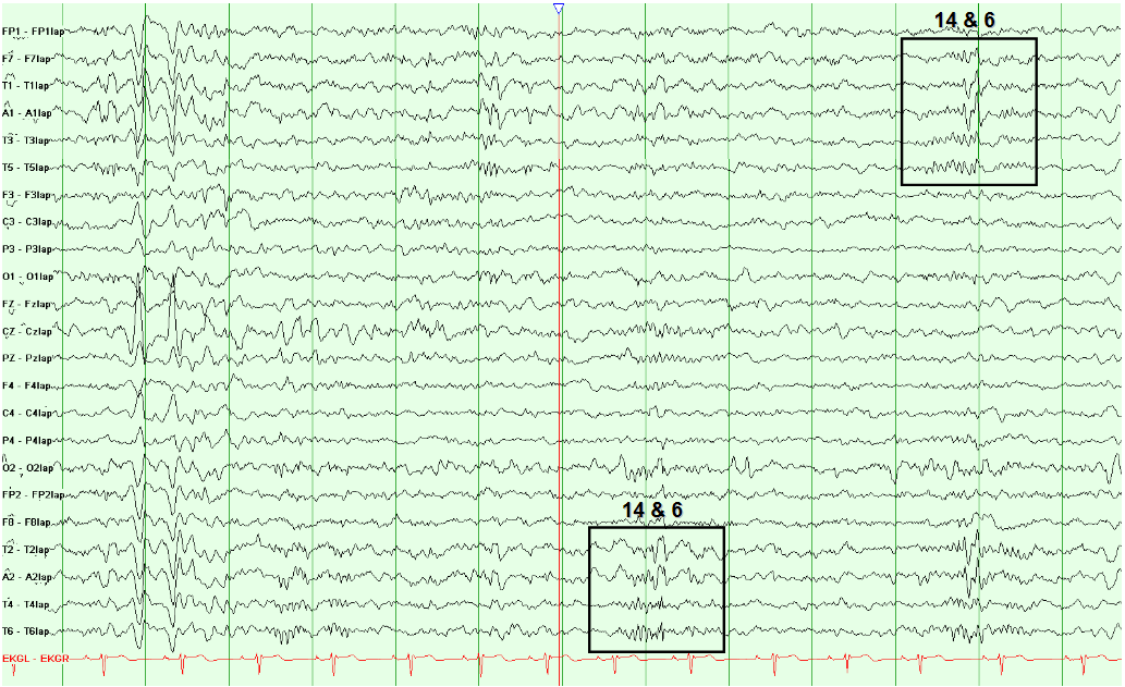 14 and 6 Positive Bursts