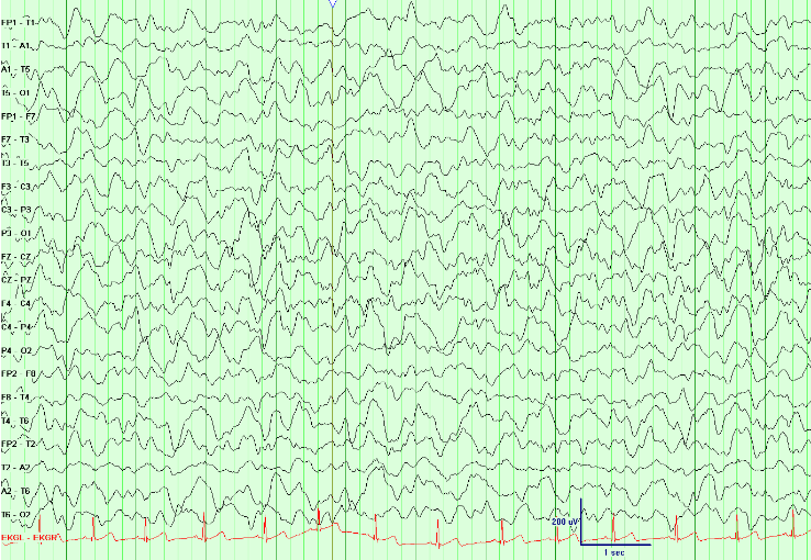 N3 sleep is characterized by the increasing percentage of high voltage delta waves of >20% of the epoch.