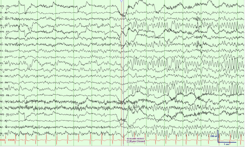 well-developed 7 Hz posterior rhythm of a 2-year-old