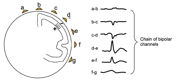 Chain of bipolar channels