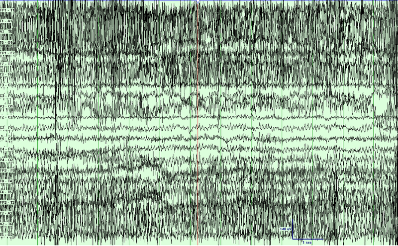 File:Muscle Artifact.png