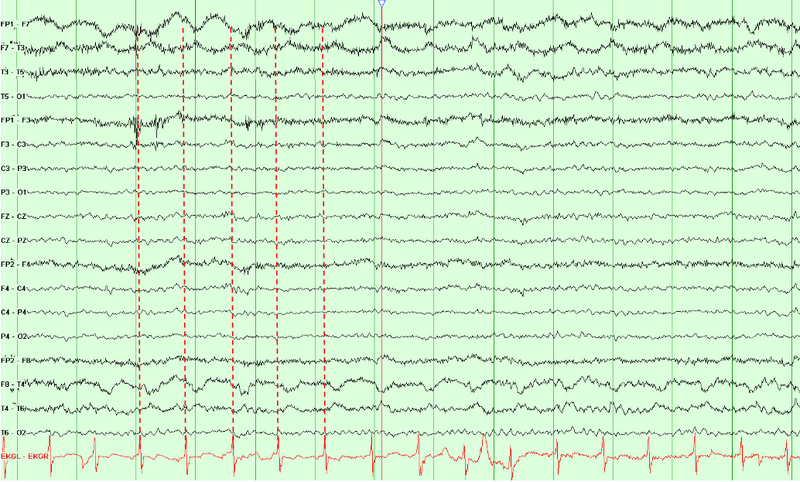 File:Pulse artifact.png