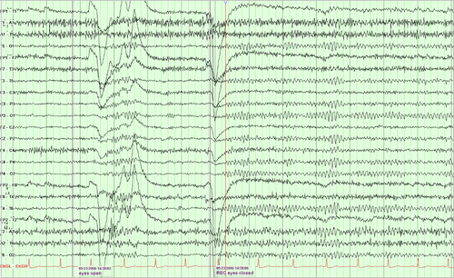 95 year old EEG
