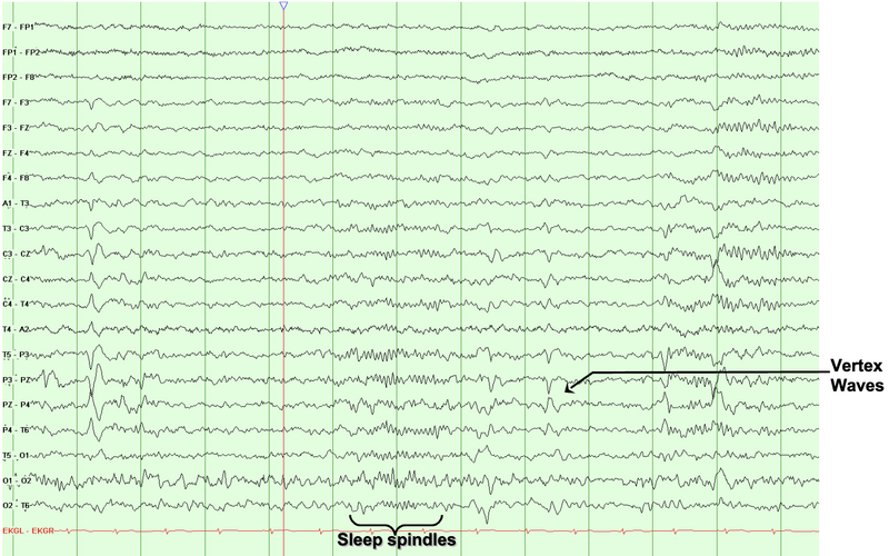 vertex waves and sleep spindles become more apparent.
