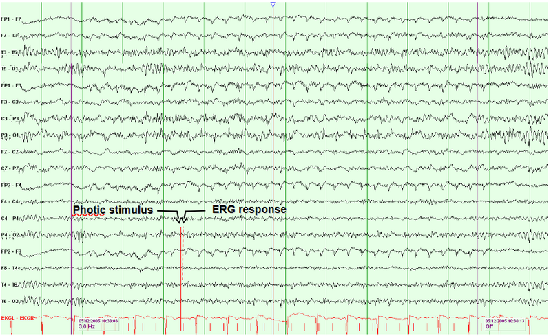 File:Electroretinogram.png