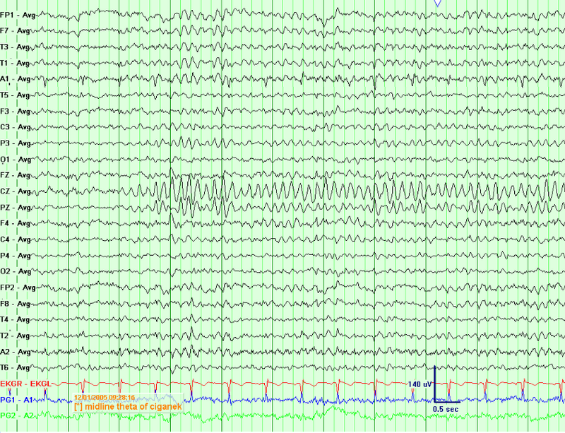 Central/Midline Theta Rhythm of Ciganek