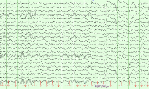 8 year old EEG with less delta more theta compared to 2 year old EEG