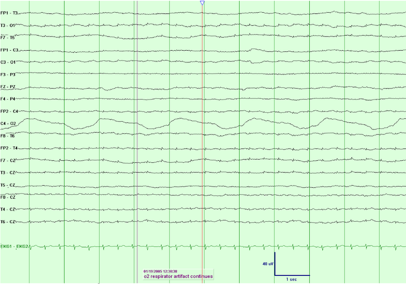 File:Electrocerebral Inactivity (ECI).png