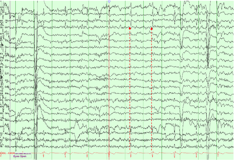 File:Electrocardiographic Artifacts.png