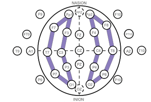 Anterior Posterior Longitudinal Bipolar Montage