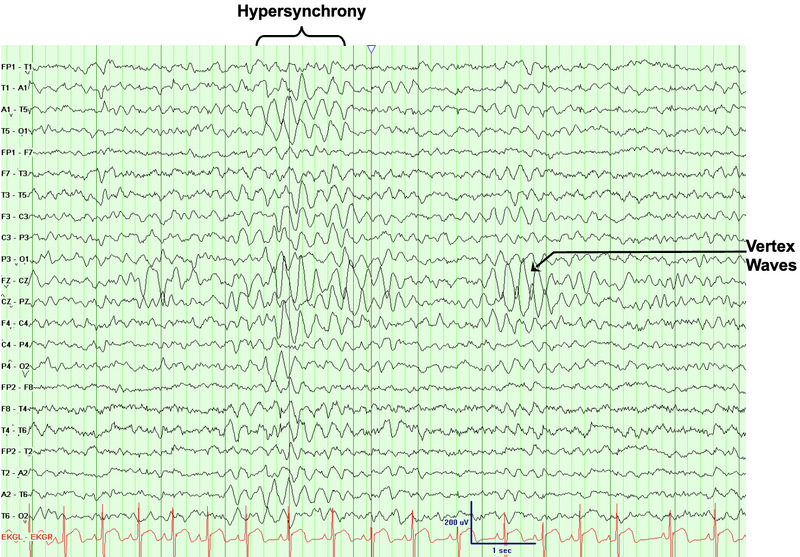 The appearance of hypnagogic hypersynchrony and triangular vertex waves