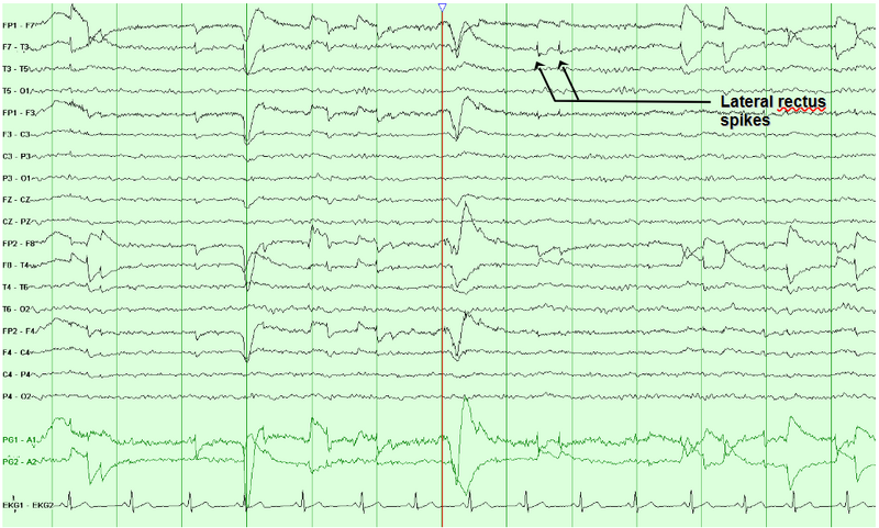 File:Electromyographic Artifacts.png