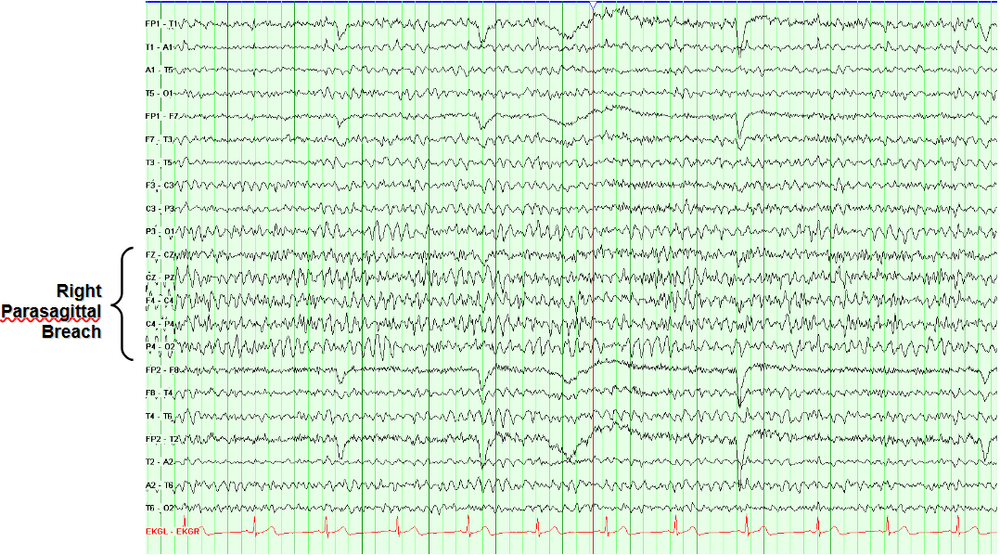 Breach rhythm