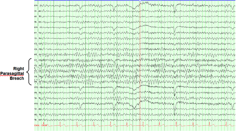 File:Breach rhythm.png